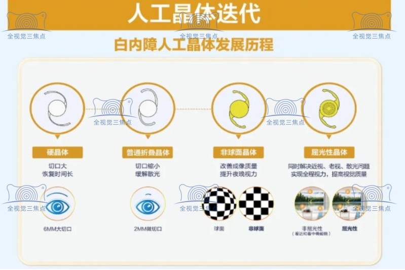 白内障人工晶体发展过程