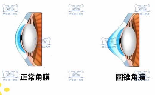 角膜过薄
