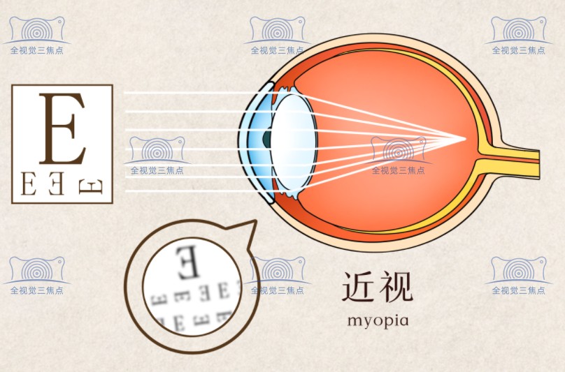 近视眼激光矫正手术各地价格8500元起