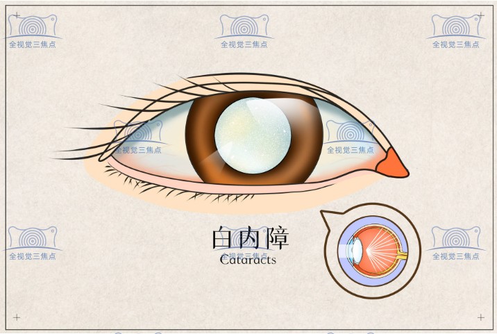 白内障晶体手术多少钱