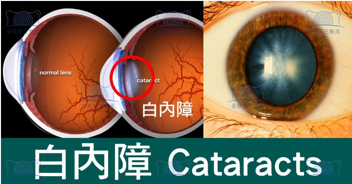 白内障晶体植入手术价格表