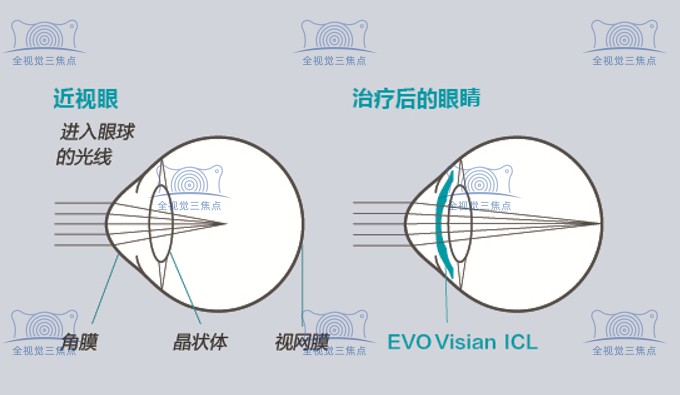 采用多焦点人工晶体手术后的眼睛变化www.sanjiaojingti.com