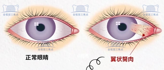 眼睛胬肉与正常眼睛对比