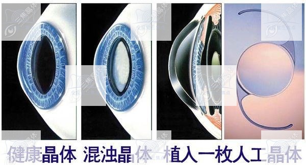 美国爱尔康晶体sn60wf对视觉有什么影响