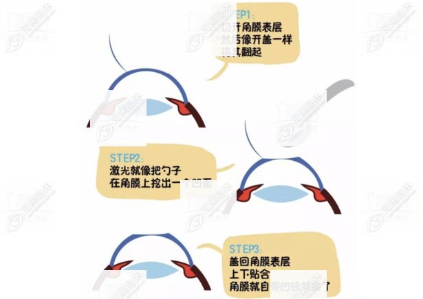 半飞秒激光手术的后遗症有哪些