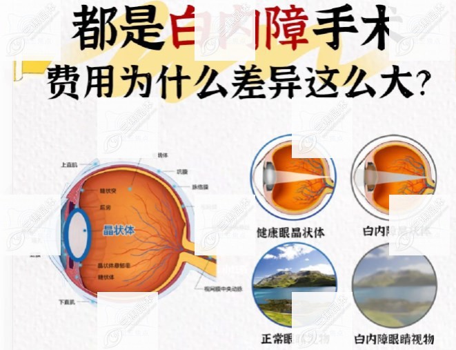 白内障眼睛和正常眼睛区别sanjiaojingti.com