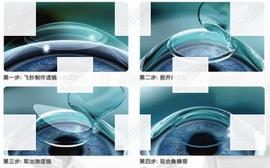 半飞秒激光手术后遗症是什么www.sanjiaojingti.com
