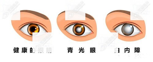 青光眼植入人工晶体的优缺点www.sanjiaojingti.com