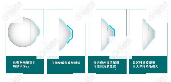 角膜塑形镜<span style=