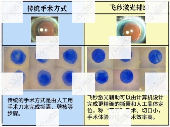 白内障超声乳化和飞秒激光辅助手术的区别