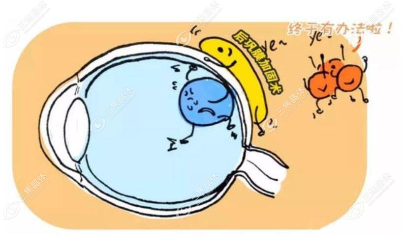 后巩膜加固术sanjiaojingti.com