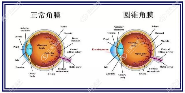 圆锥角膜和正常角膜的区别