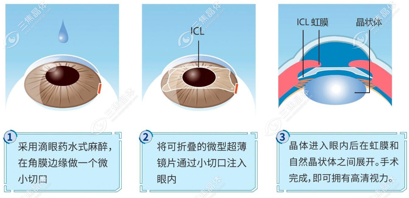 圆锥角膜能做ICL晶体植入手术sanjiaojingti.com