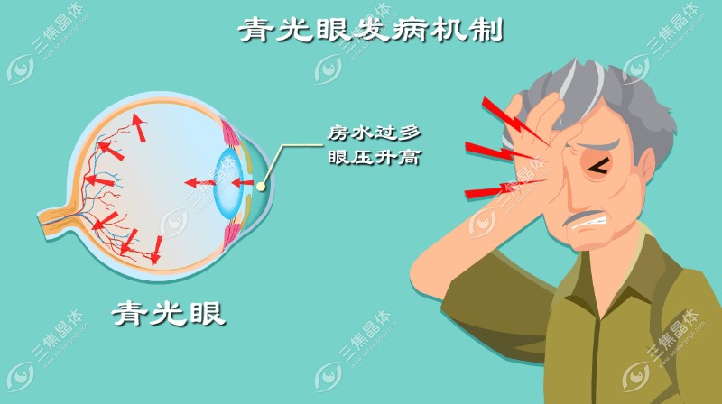 青光眼发病机制介绍