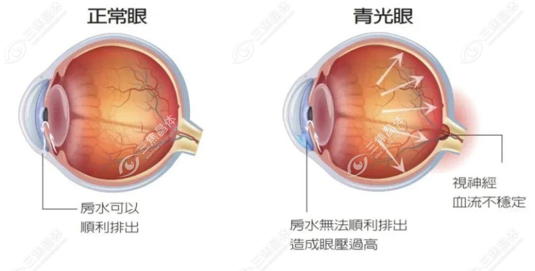 青光眼可以植入人工晶体提高视力吗？