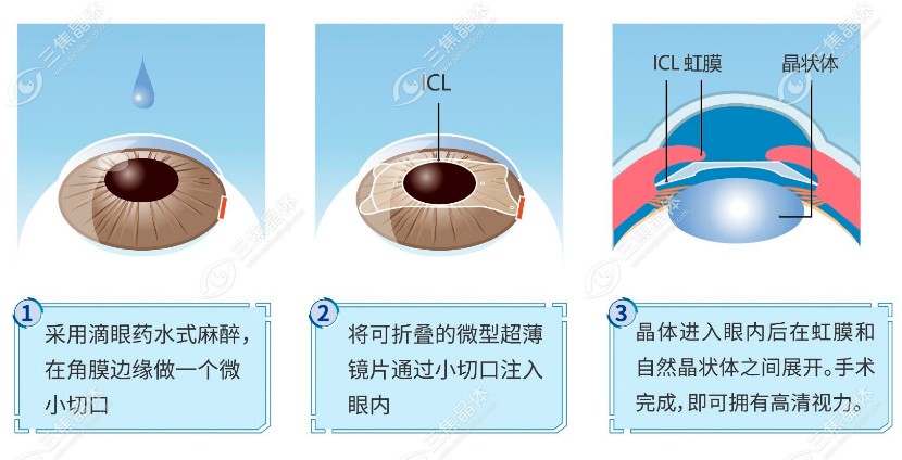 济南明水眼科晶体植入术手术费用：3万元起