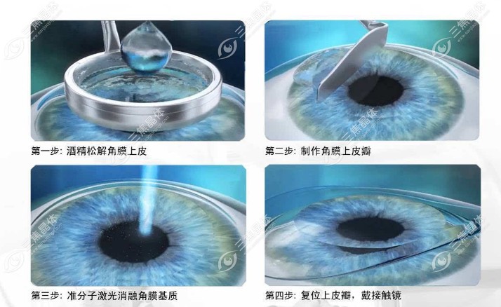 济南明水眼科半飞秒手术价格：10800元起
