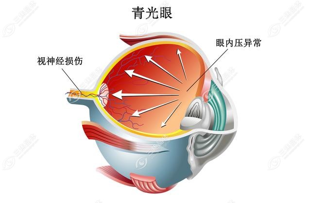 青光眼人工晶体植入可使用多少年?www.sanjiaojingti.com