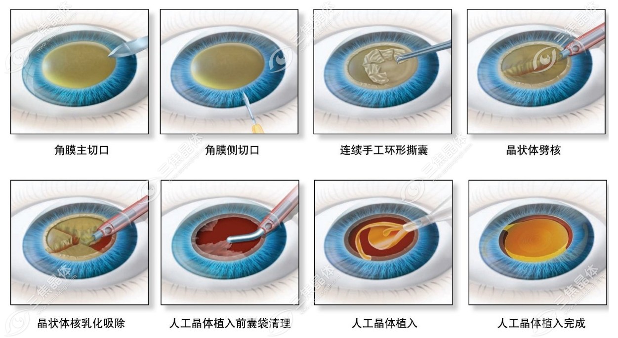 双焦点人工晶体植入后痛不欲生,才发现我并不适合双焦晶体