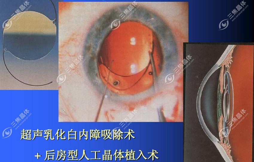 什么人不适合做双焦点人工晶体