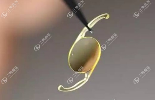 白内障植入的人工晶体的使用寿命