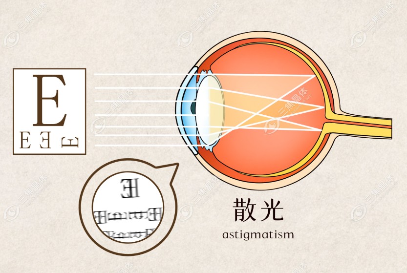 散光恢复训练www.sanjiaojingti.com