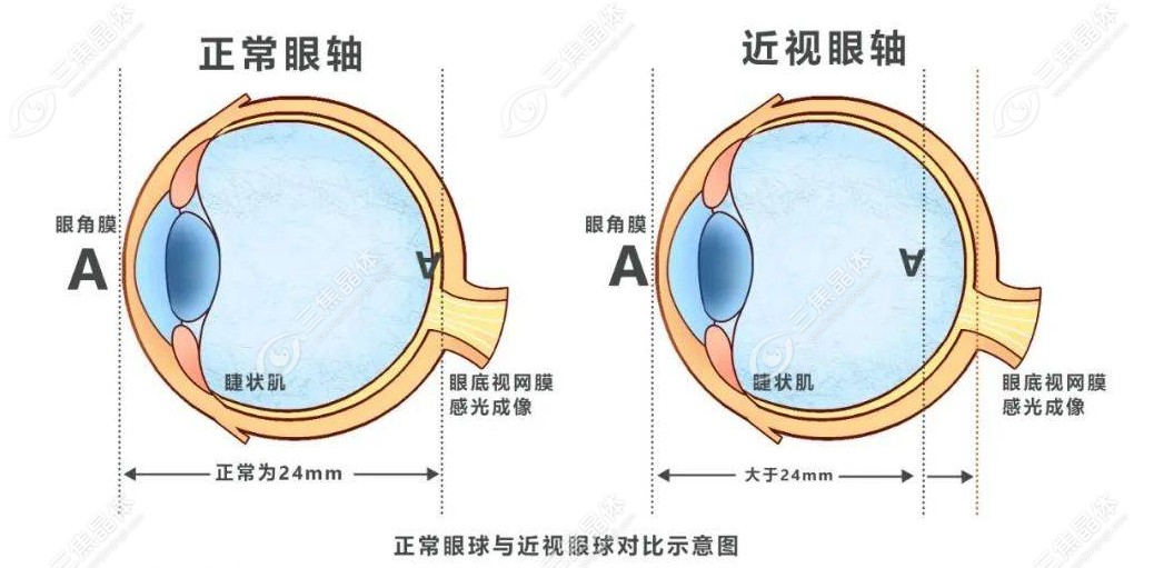 儿童眼轴发育标准对照表~三焦晶体