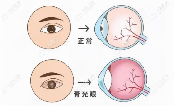 多种原因都会引起眼压高