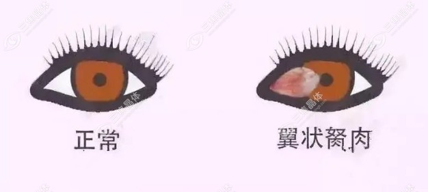 眼睛翼状胬肉手术费用有报销吗