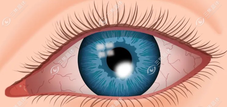 眼睛18种病的图片大全【角膜溃疡】