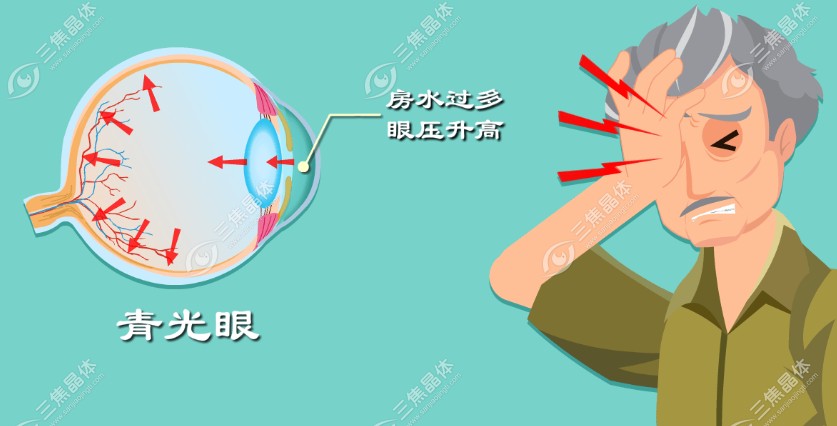 眼睛18种病的图片大全【青光眼】