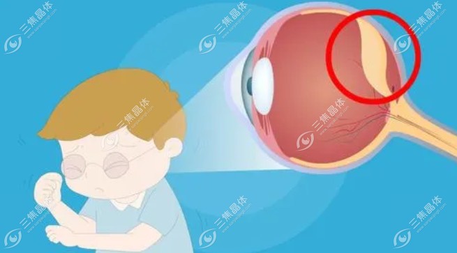 眼睛18种病的图片大全【视网膜脱离】