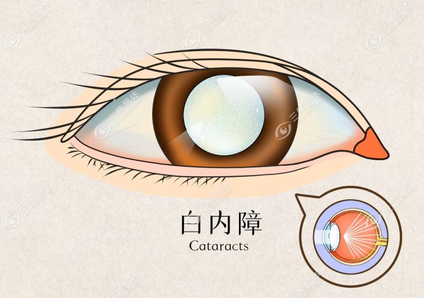 眼睛18种种病的图片大全之一