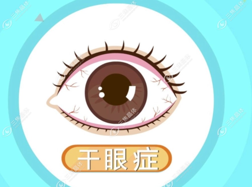 眼睛18种病的图片大全【干眼症】