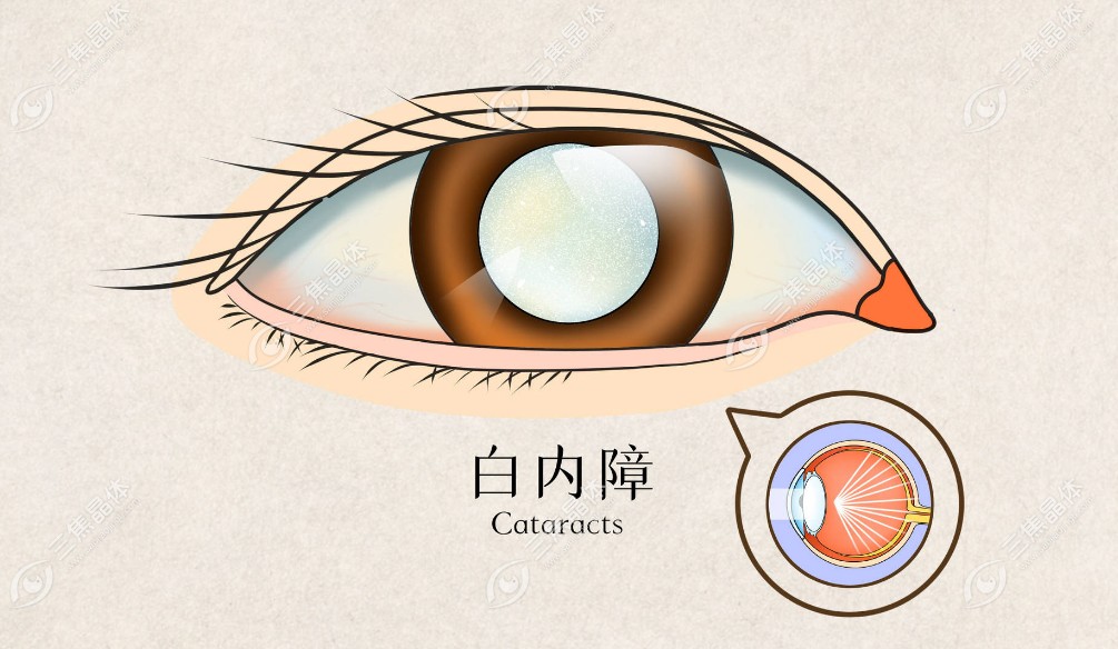 晶状体混浊是不是就是白内障引起的,眼睛可以自行恢复吗