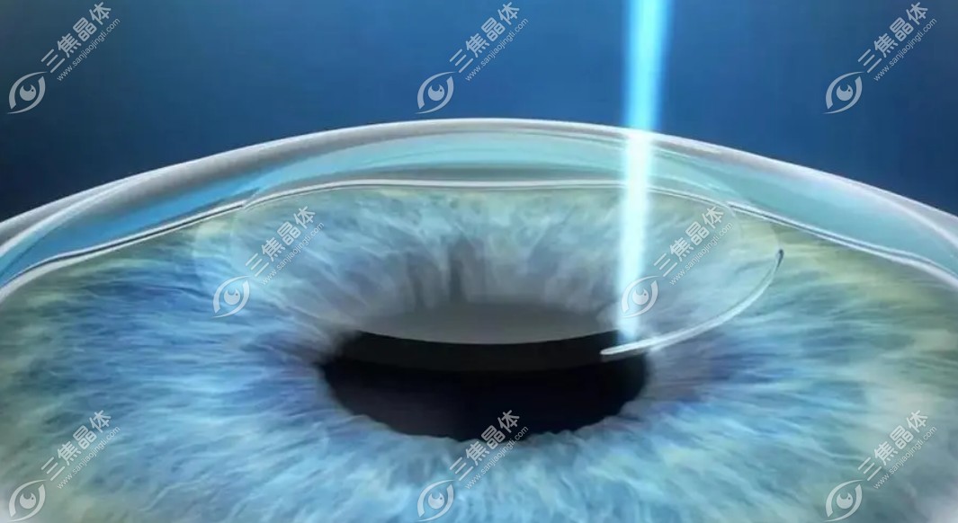视力矫正手术值不值得做