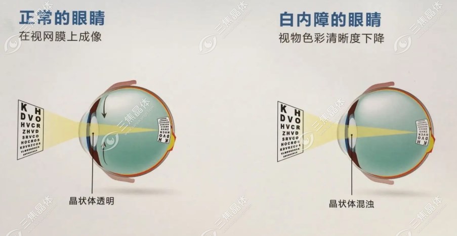 国产蕾明视康人工晶体价格表