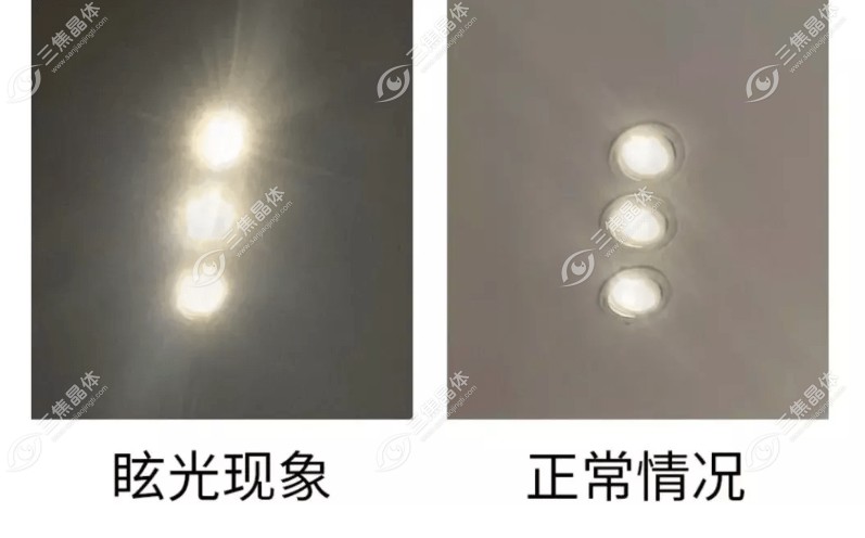 眼睛眩光可以改善