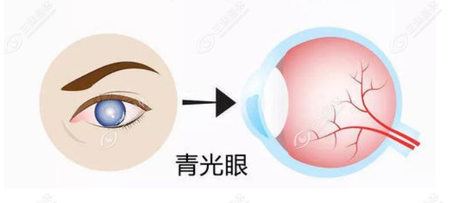 判断自己是不是青光眼的小方法