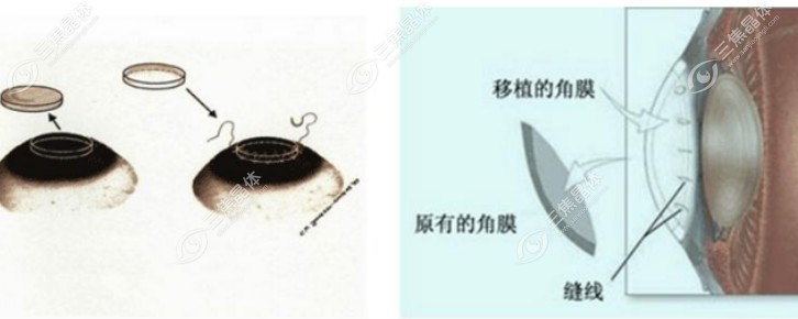 板层角膜移植寿命在10-20年左右
