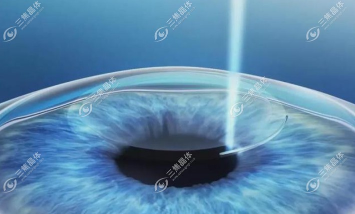 上海全飞秒手术哪家医院好？上海和平眼科、新视界眼科等技术都不错