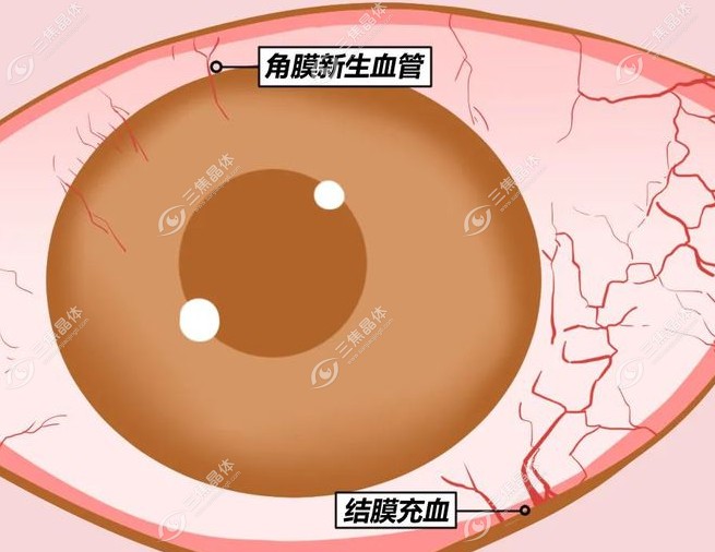 角膜新生血管可以做近视眼手术吗www.sanjiaojingti.com