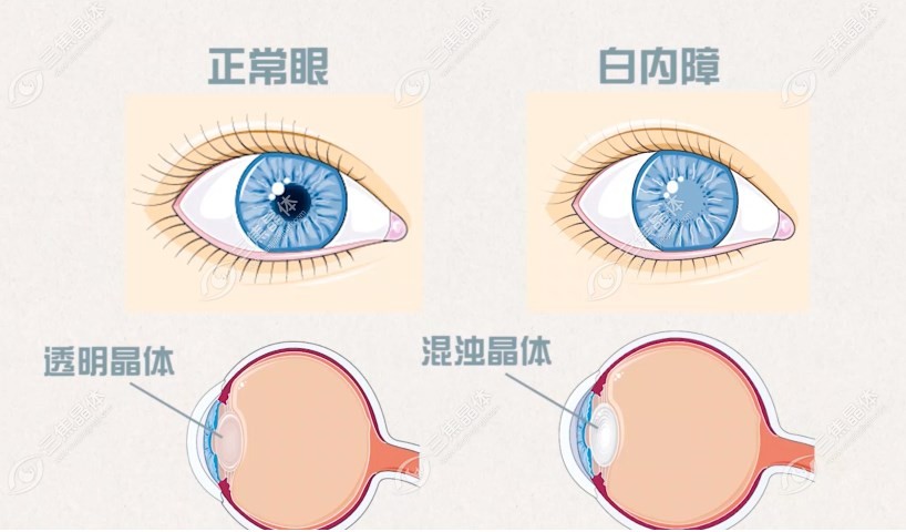 白内障人群适合做三焦点人工晶体@三焦晶体