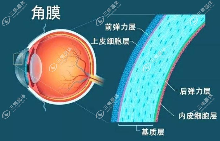 角膜内皮失代偿一定做角膜移植吗？不一定！
