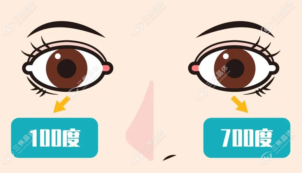 两个眼睛度数相差较大可以做近视眼手术么www.sanjiaojingti.com