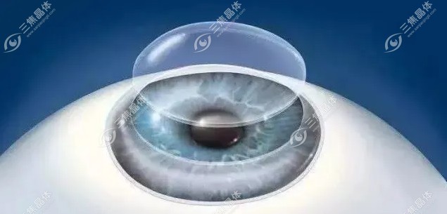 两个眼睛度数相差大做近视手术是较好的选择~三焦晶体
