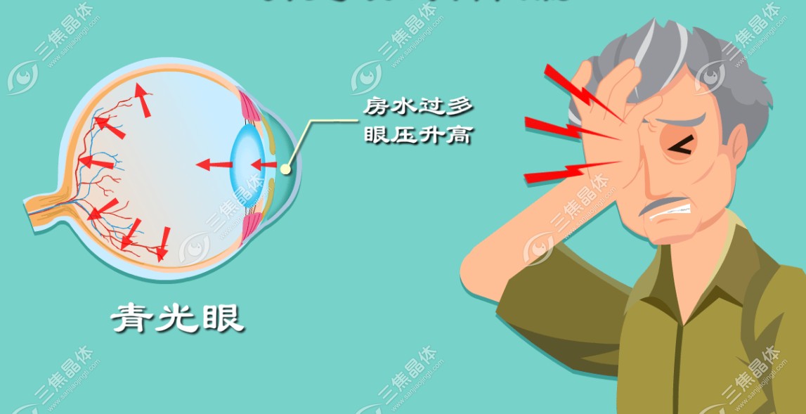 青光眼人群适合三焦点人工晶体