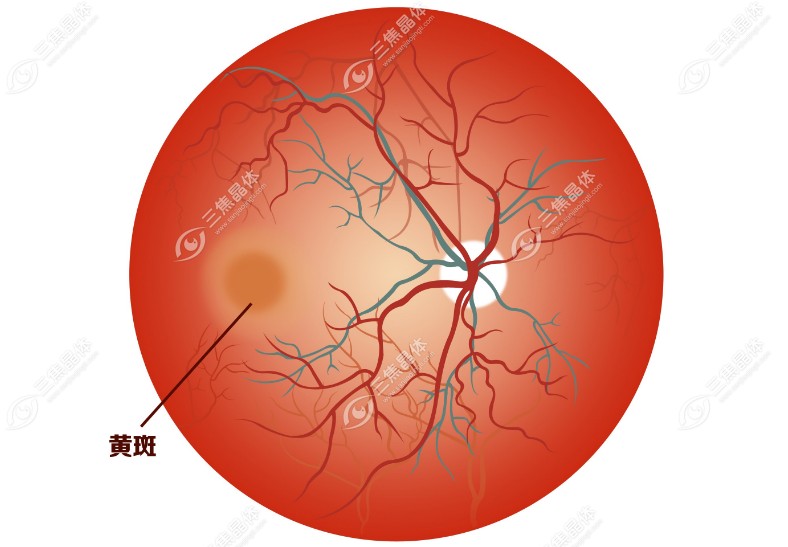 眼底黄斑前膜一定要手术治疗吗?不一定