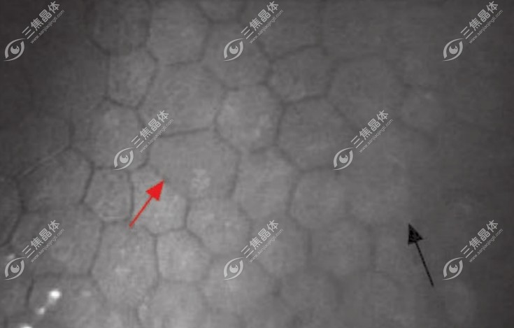 角膜内皮细胞形态异常www.sanjiaojingti.com