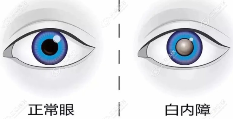 良心医生说千万别做单眼白内障手术